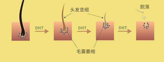 为什么脱发钟爱男性？